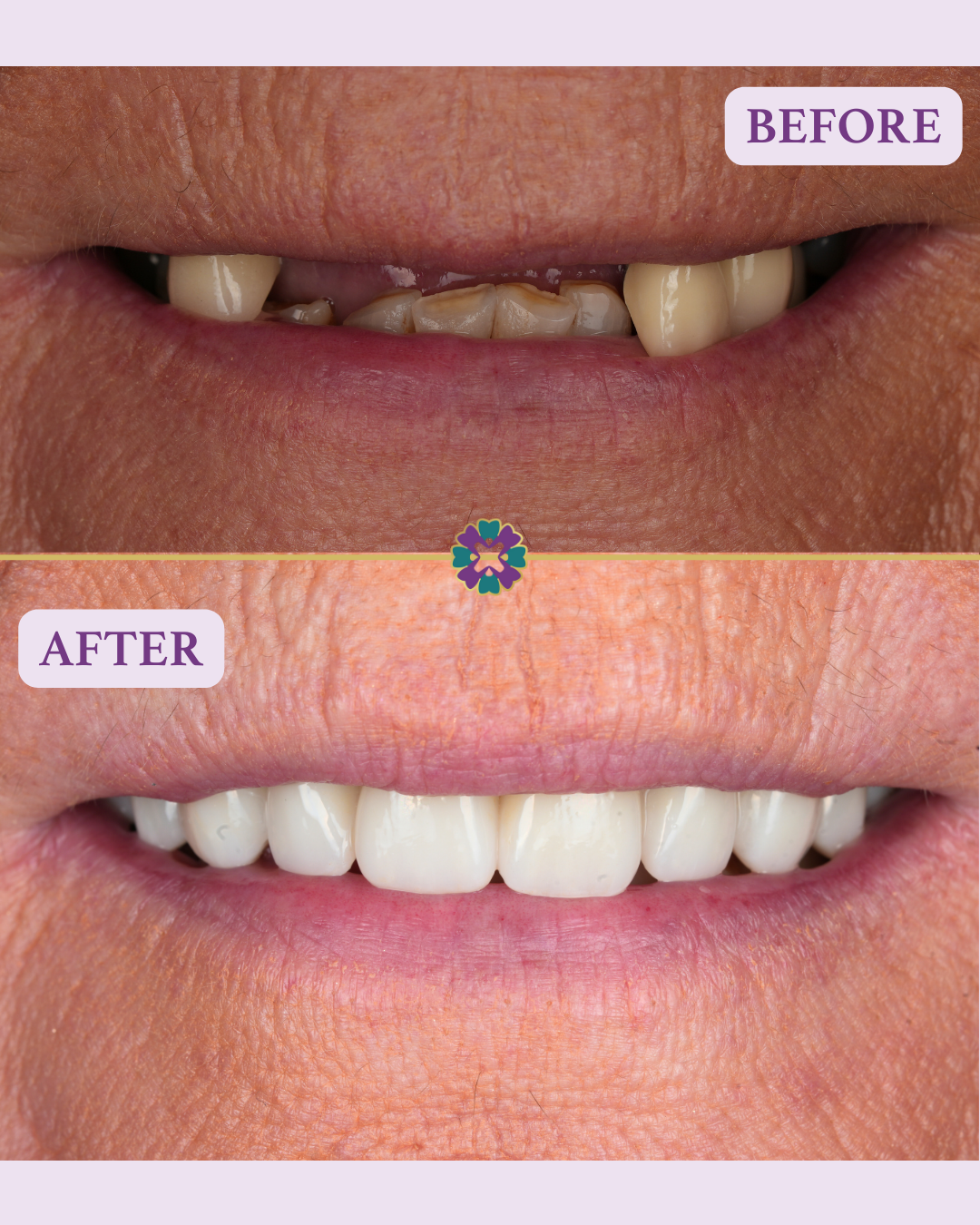 ABD implants before and after (14)